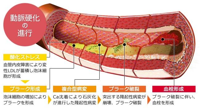 LOX-index 動脈硬化3.jpg