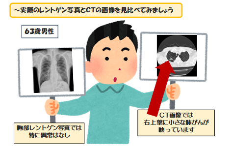 低線量肺がんＣＴ検診を始めました！